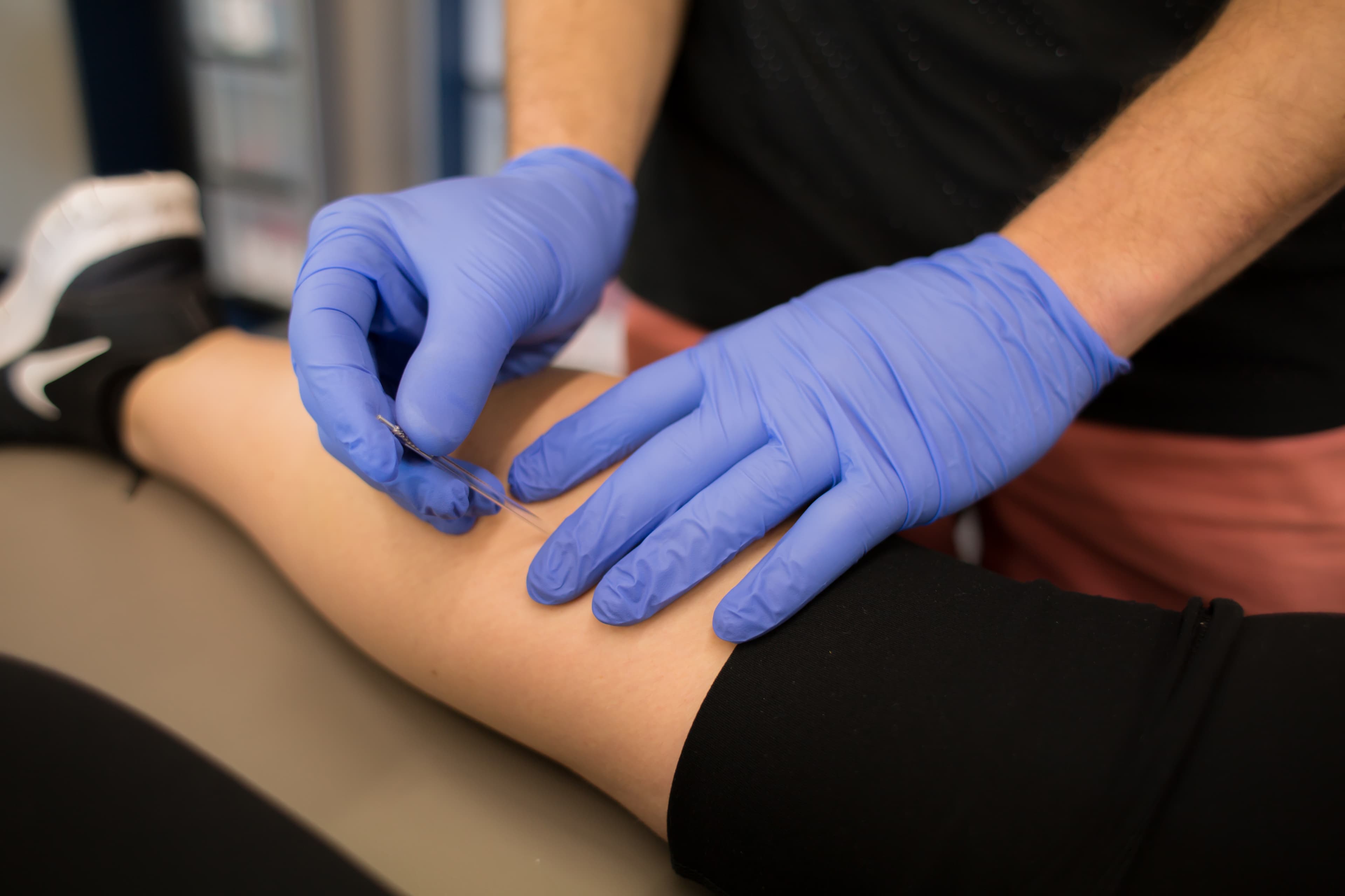 Gloved hands placing a dry needle in a patient's forearm